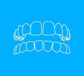 Diastema